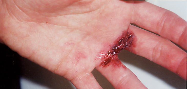 Fingerverletzung